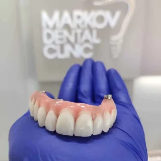 all on 4 zubni implanti privremeni fiksni rad