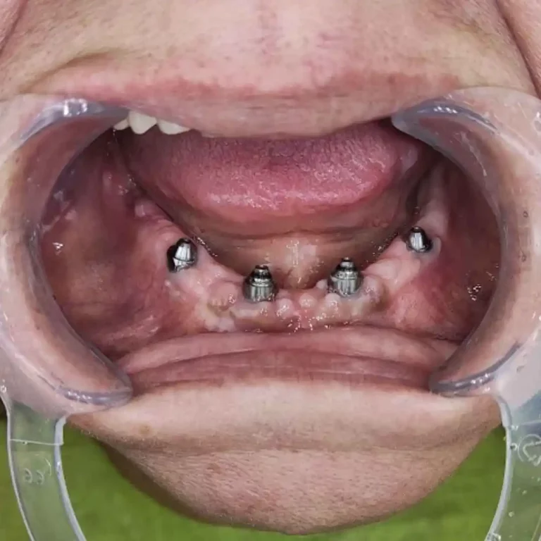 all on 4 zubni implanti ugradnja