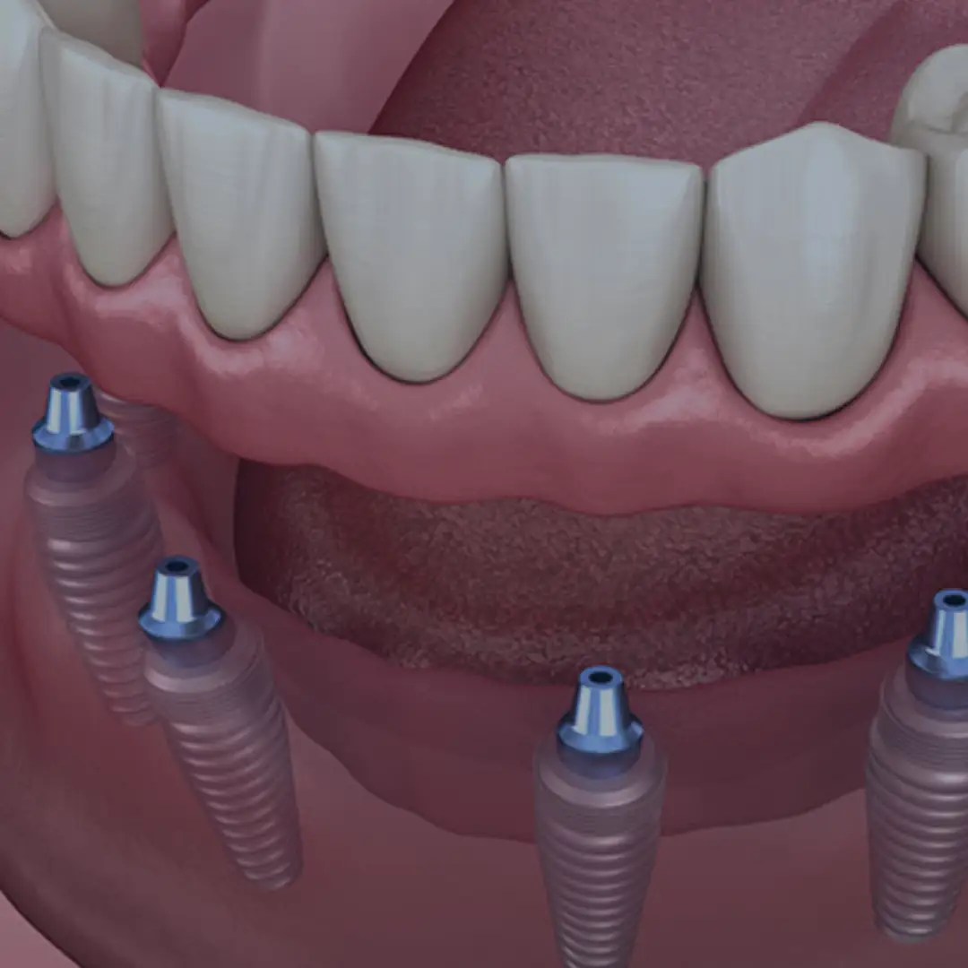 all on 4 zubni implanti