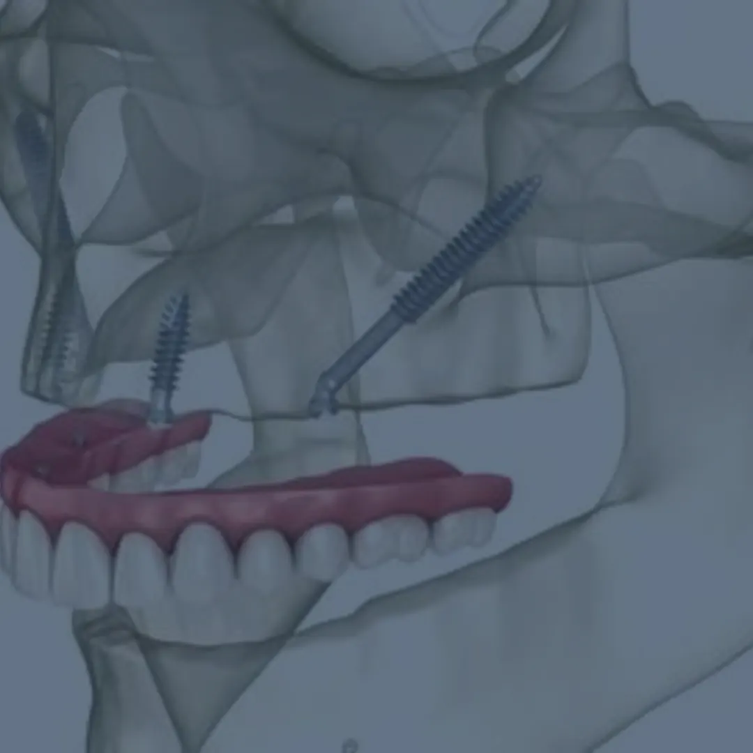 zigomaticni zubni implanti